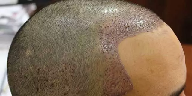 Saç Ekimi Sonrası Şişlik Sorunu