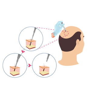 DHI Saç Ekimi Doğal Çözüm