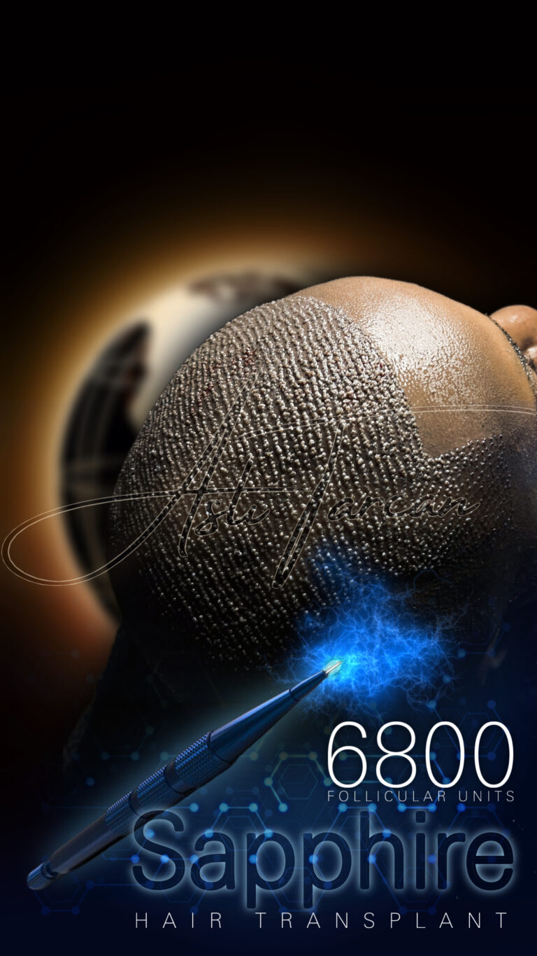 Saç Ekimi Sonrası Saçlar Ne Zaman Çıkar?