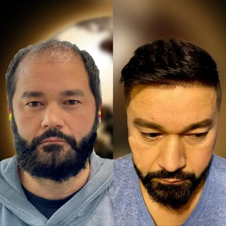 Saç Ekimi Sonrası Saçlar Ne Zaman Çıkar?