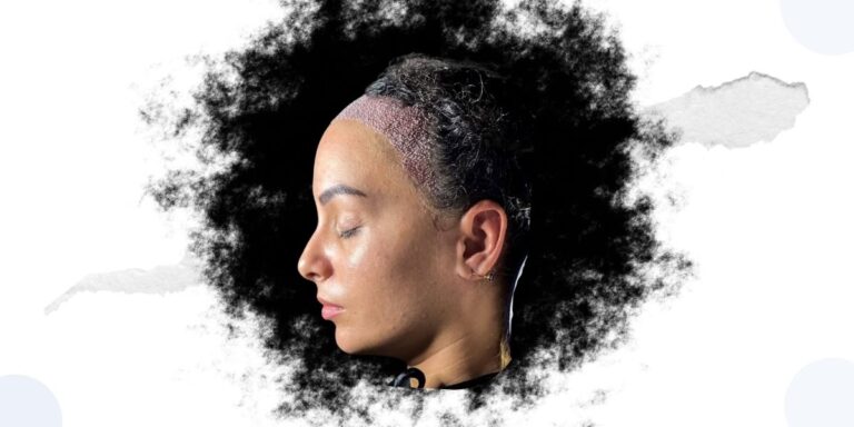 Saç Ekimi Acılı Bir İşlem Mi?