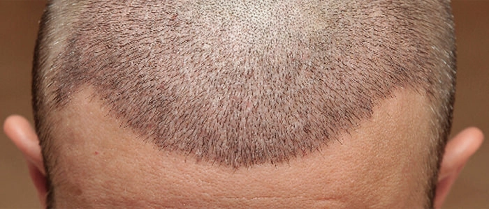 Saç Ekimi Sonrası Bakım