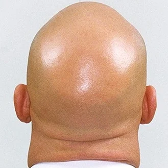 Genetik Saç Dökülmesi Nedenleri Ve Tedavi Yöntemleri