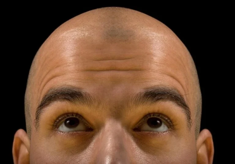 Saç Ekimi Kaç Saat Sürüyor?