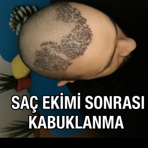 sac_ekimi_kabuklanma_300x300