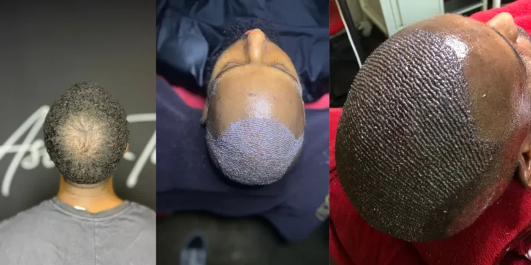 Ikinci Saç Ekimi Yapılır mı?