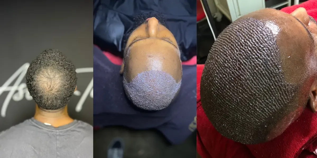 Ikinci Saç Ekimi Yapılır mı?