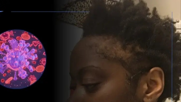 Saç Dökülmesine Neden Olan Virüsler