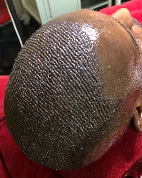 Saç ekimi ne zaman yapılmalıdır?